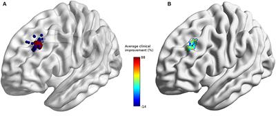 Baseline Clinical and Neuroimaging Biomarkers of Treatment Response to High-Frequency rTMS Over the Left DLPFC for Resistant Depression